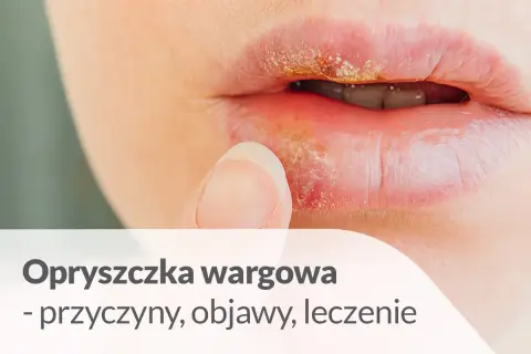 Zbliżenie na usta z widoczną opryszczką wargową. Palec wskazujący dotyka wargi, gdzie widać zaczerwienienie i strupki.