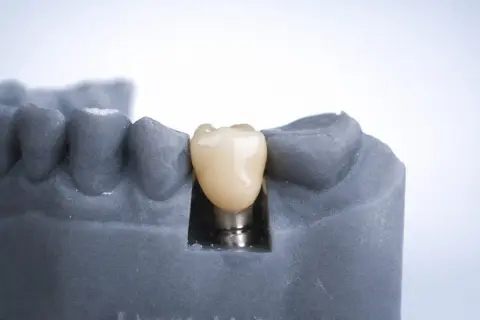 Model szczęki z szarego materiału, na którym widoczny jest implant jednofazowy z białym zębem.