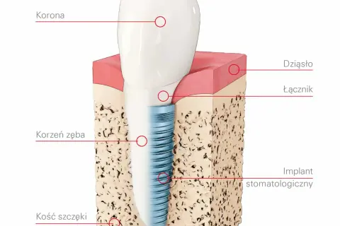 Co to jest implant zęba? Wszystko, co musisz wiedzieć o korzyściach i procesie implantacji