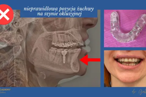 Rentgen żuchwy z nieprawidłową pozycją na szynie okluzyjnej. Obok szyna Essex i uśmiech pacjentki.