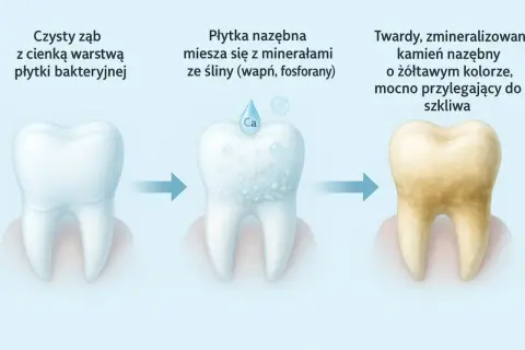 Proces powstawania kamienia nazębnego: od czystego zęba, przez mieszanie płytki z minerałami, aż do twardego, żółtawego kamienia. Skaling jest kluczowy.