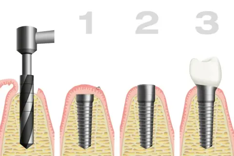 Etapy wszczepienia implantu zęba siódemki: wiercenie, implantacja, odbudowa.