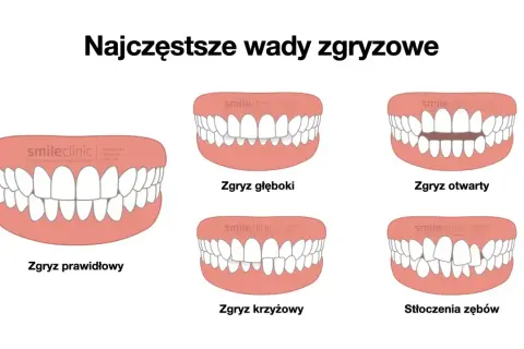 Zgryz prawidłowy to idealne ułożenie zębów. Obok wady zgryzowe: głęboki, otwarty, krzyżowy i stłoczenia.