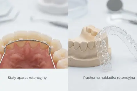Dwa rodzaje aparatów retencyjnych: stały, widoczny na zębach, oraz ruchoma nakładka na gipsowym modelu.
