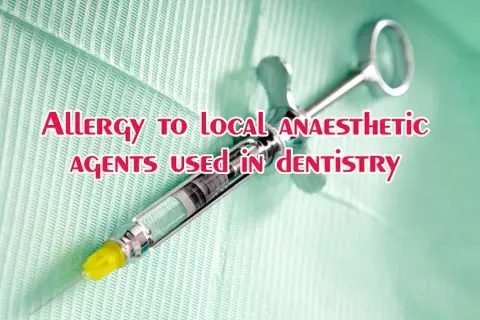 Objawy uczulenia na znieczulenie u dentysty – jak rozpoznać i zapobiec reakcji alergicznej