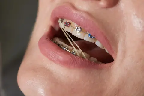 Usta z aparatem ortodontycznym, na którym widoczne są gumki elastyczne, czyli wyciągi międzyszczękowe, korygujące zgryz.