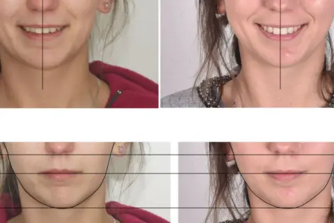 Czy aparat na zęby naprawdę zmienia kształt twarzy? Sprawdź, jak wpływa na rysy