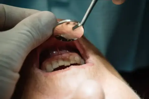 Dentysta bada ząb, szukając sposobu, jak pozbyć się ropy.