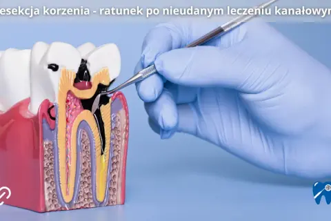 Model zęba z widocznym uszkodzeniem korzenia, gdzie stomatolog wykonuje zabieg resekcji korzenia zęba.