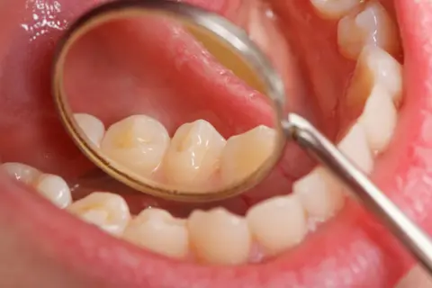 Widoczne białe plamy na zębach u dziecka, widoczne w lusterku dentystycznym.
