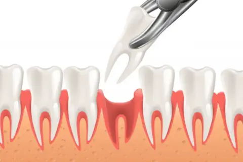 Co dentysta wkłada do zęba po usunięciu? Wyjaśniamy proces i zalecenia po zabiegu