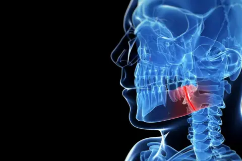Anatomia szczęki z zaznaczonym obszarem bólu, który może być spowodowany skurczem szczęki przy ziewaniu.