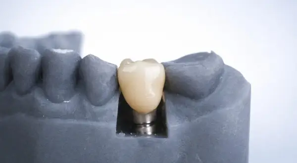 Model szczęki z szarego materiału, na którym widoczny jest implant jednofazowy z białym zębem.