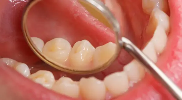 Widoczne białe plamy na zębach u dziecka, widoczne w lusterku dentystycznym.