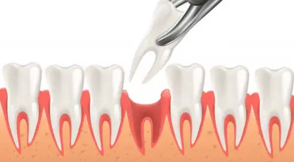 Co dentysta wkłada do zęba po usunięciu? Wyjaśniamy proces i zalecenia po zabiegu
