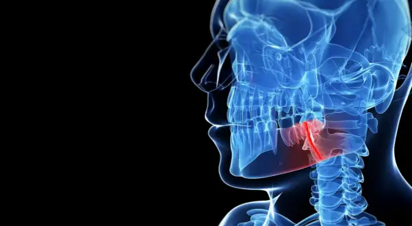Anatomia szczęki z zaznaczonym obszarem bólu, który może być spowodowany skurczem szczęki przy ziewaniu.