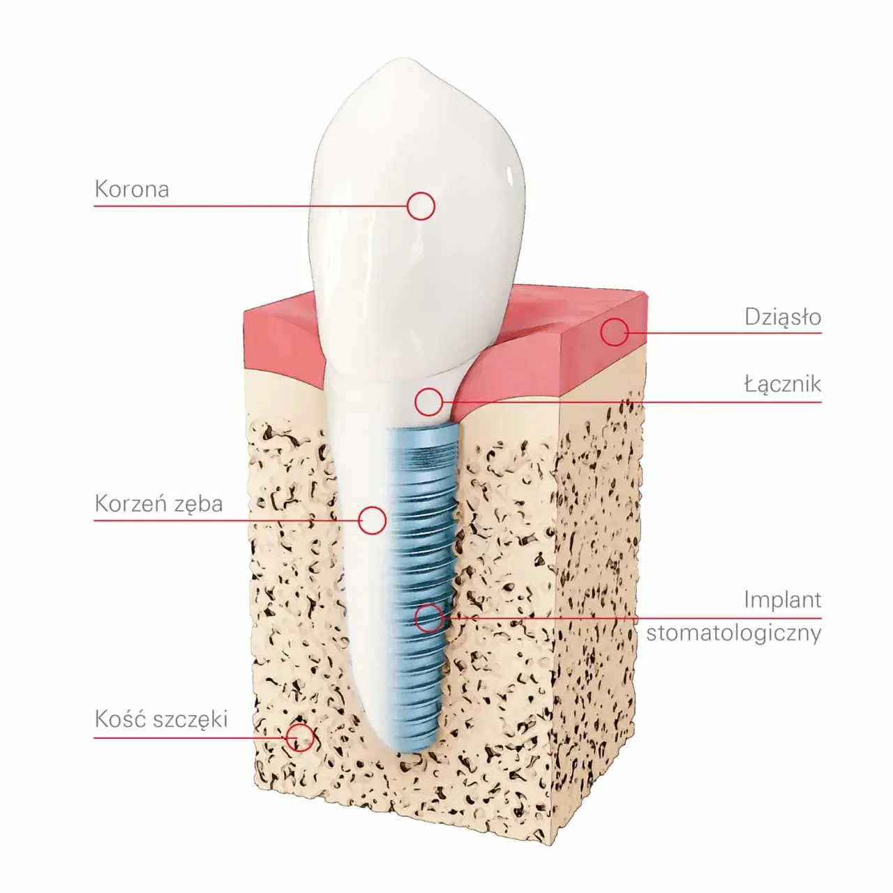 Co to jest implant zęba? Wszystko, co musisz wiedzieć o korzyściach i procesie implantacji