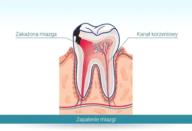 Zdjęcie Czy zepsuty ząb może powodować ból głowy? Sprawdź związek i rozwiązania