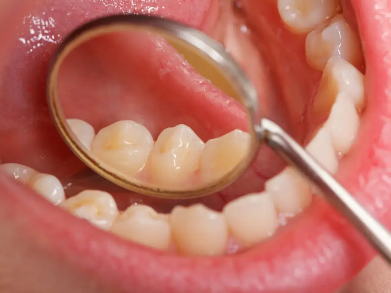 Usta z lustrem dentystycznym, które odbija zęby. Widać nalot na zębach, co może być sygnałem do wizyty u stomatologa.
