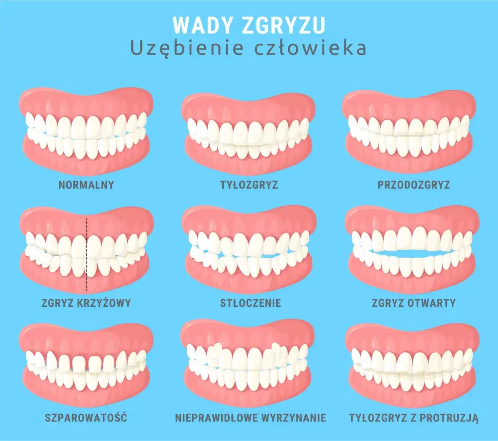 Zdjęcie Na jakie zęby zakłada się aparat? Wszystko o leczeniu wad zgryzu i rodzajach aparatów