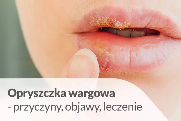 Zbliżenie na usta z widoczną opryszczką wargową. Palec wskazujący dotyka wargi, gdzie widać zaczerwienienie i strupki.