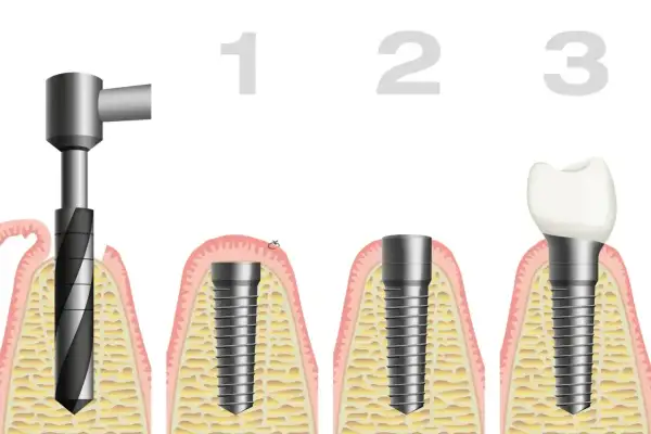 Etapy wszczepienia implantu zęba siódemki: wiercenie, implantacja, odbudowa.