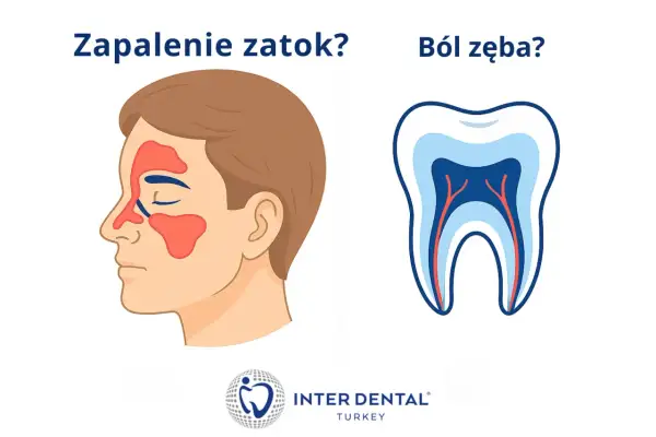 Zapalenie zatok czy ból zęba? Ilustracja pokazuje zatoki nosowe i przekrój zęba, sugerując, że ból zębów po jednej stronie może być mylony z zapaleniem zatok.