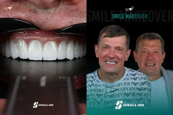 Nowy, olśniewający uśmiech po zabiegu w Turcji. Porównanie przed i po metamorfozie zębów.