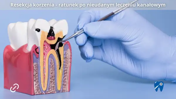 Model zęba z widocznym uszkodzeniem korzenia, gdzie stomatolog wykonuje zabieg resekcji korzenia zęba.